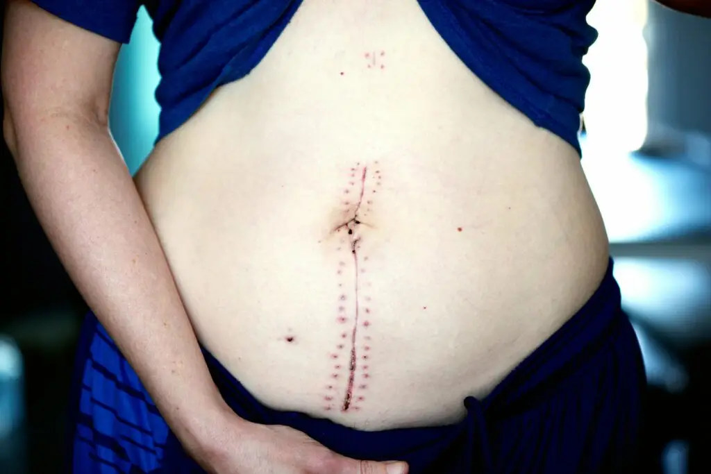 Close-up image showing a healing scar on a woman's abdomen post-surgery.