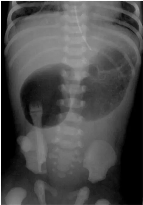 Abdominal X-ray showing double bubble sign, indicating duodenal atresia. Two air-filled bubbles are visible representing the stomach and duodenum.