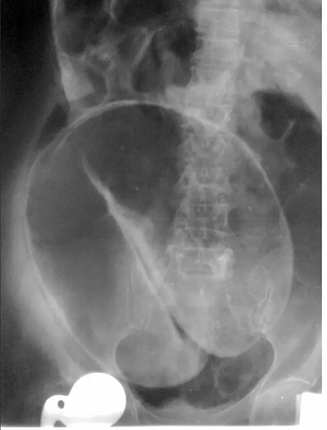Abdominal X-ray demonstrating the 'coffee bean sign,' a diagnostic indicator of sigmoid volvulus, a condition where the sigmoid colon twists on itself.