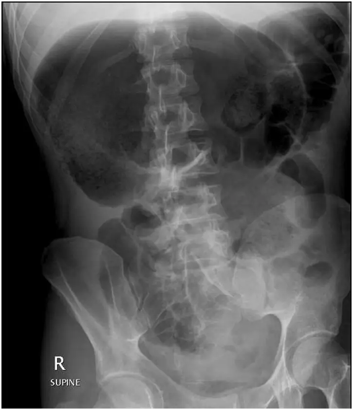 Abdominal X-ray showing cecal volvulus with a distended and displaced cecum, indicating bowel obstruction.