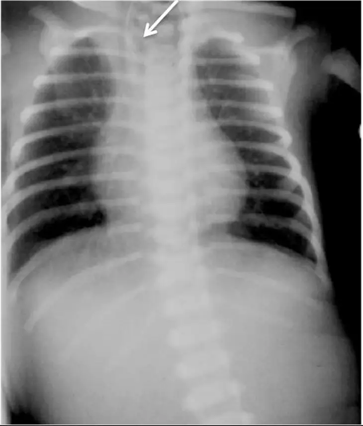 X-ray showing dilated pharyngeal pouch in esophageal atresia.