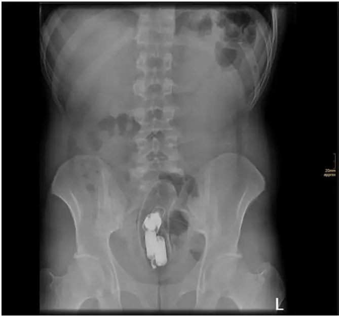 Abdominal X-ray showing a foreign body in the rectum.