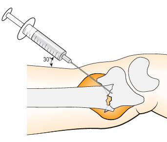 hematoma block for fracture pain relief, anesthesia techniques used in orthopedics surgery,