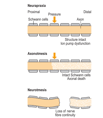 nerve injury classification, seddon classification, neurapraxia, axonotmesis, neurotmesis
