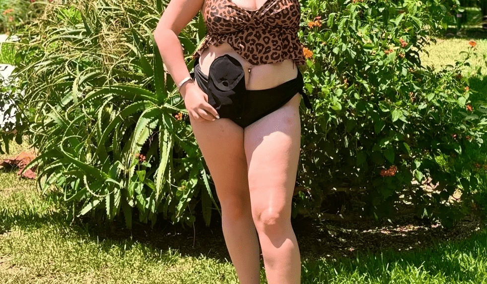 ileostomy stoma care guide for post exploratory laparatomy with ileostomy patients