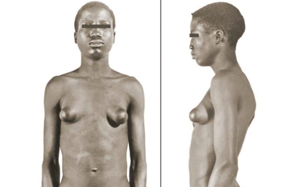 Male breast reduction surgery, male breast also known as gynecomastia