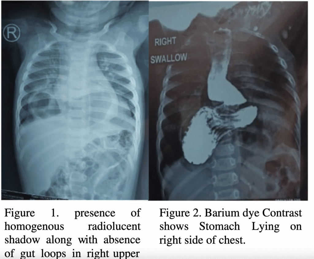 morgagni hernia, diaphragmatic hernia, congenital