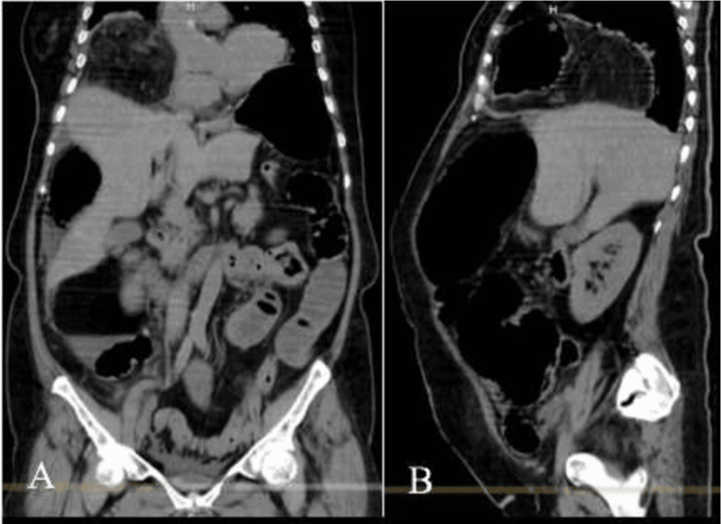 morgagni-hernia-ct-scan-diaphragmatic-hernia diaphragmatic hernia, morgagni hernia ct scan images