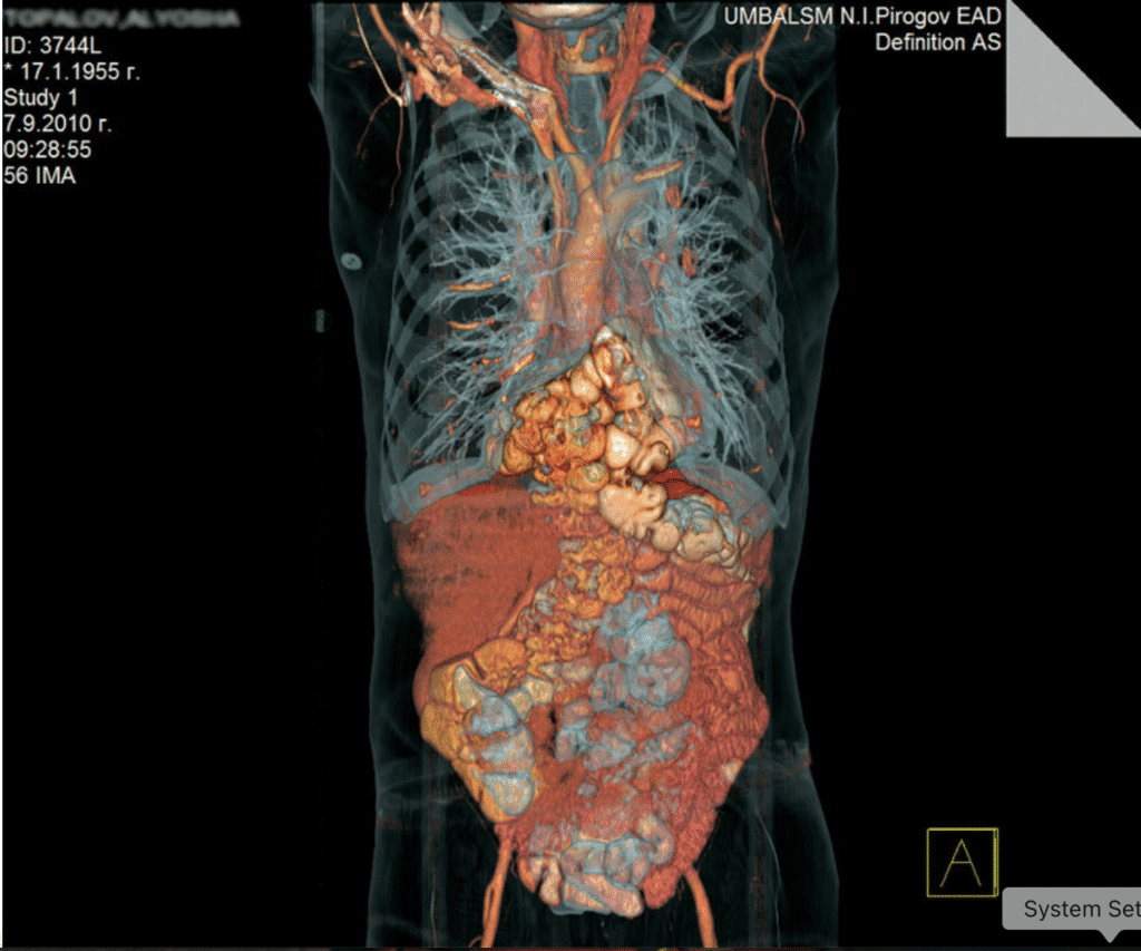 morgagni larrey hernia 3d ct scan image,