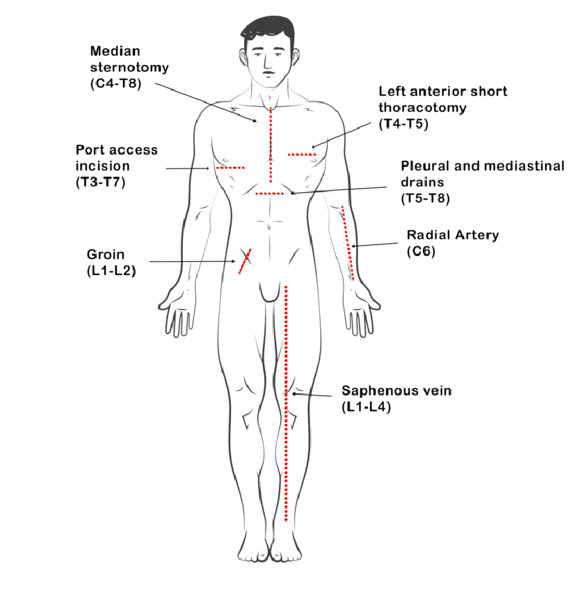 Planning the incision is very important in cardiothoracic surgery because it affects the results after surgery, the flexibility during surgery, the exposure, and the access. The pathophysiology dictates the operation; nevertheless, the feasibility of executing it effectively and safely is contingent upon the incision employed.