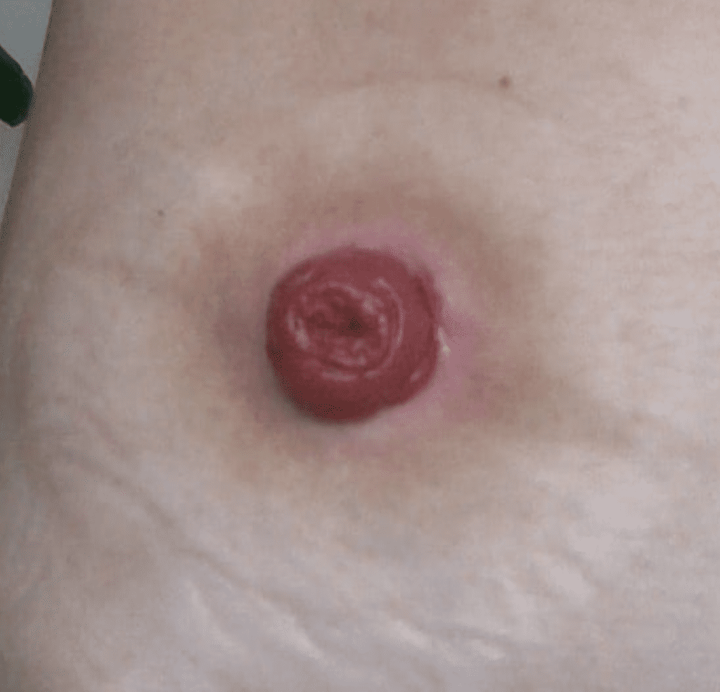 examination of a healthy stoma